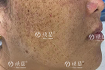 什么是雀斑