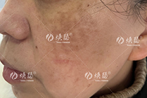 什么是真皮斑
