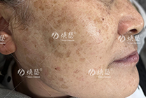 空心斑怎么治疗